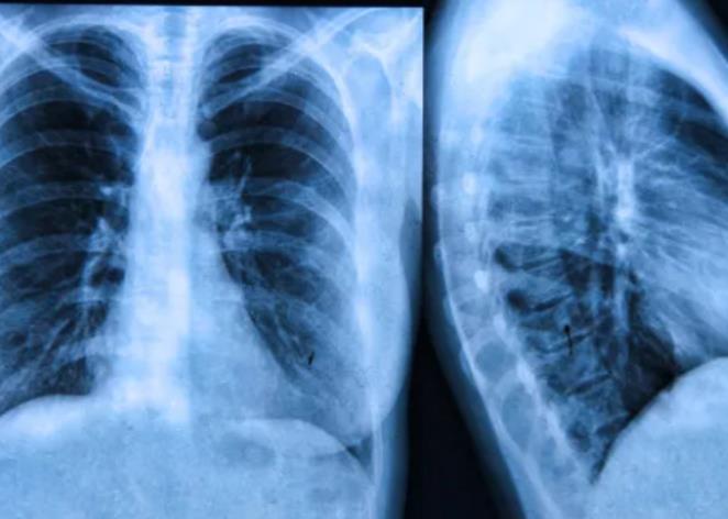 肺癌非常隐蔽，肺癌的分类有哪些？肺癌的五年存活率有多高？