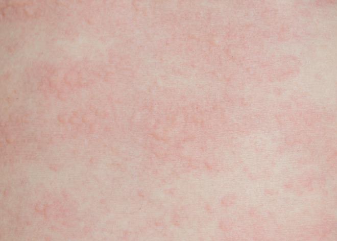 你到底是怎么得“荨麻疹”的？注意这四个因素，避免遭罪