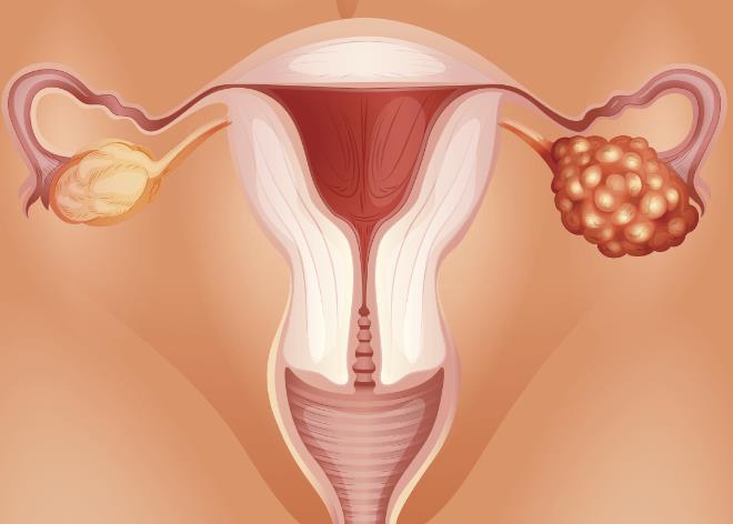 卵巢癌的症状有哪些？出现这5种症状，女性要提高警惕