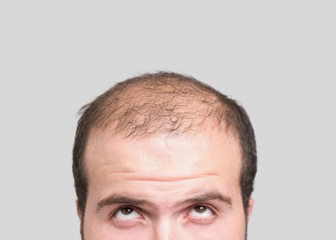 脱发是最困扰的问题之一，“四大流派”对付脱发，一一了解