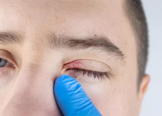 睫毛有螨虫还差点影响视力！睑缘炎经常与干眼症混淆，医生教你预防