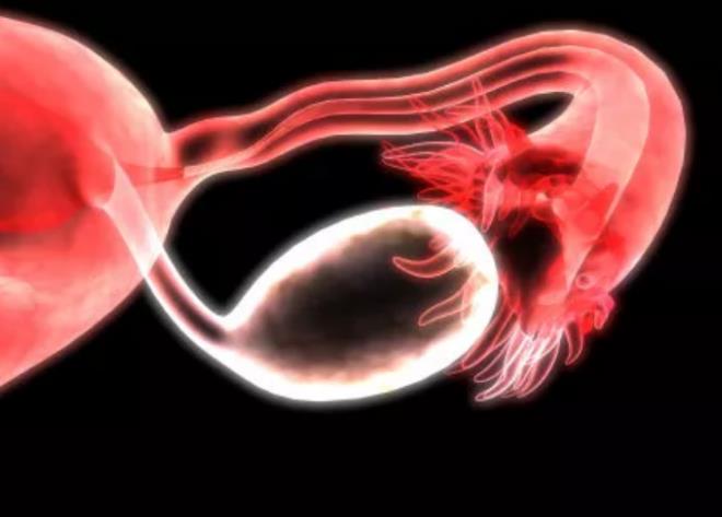 多囊对女性的危害，可能贯穿一生，3种方法有助于多囊卵巢综合症