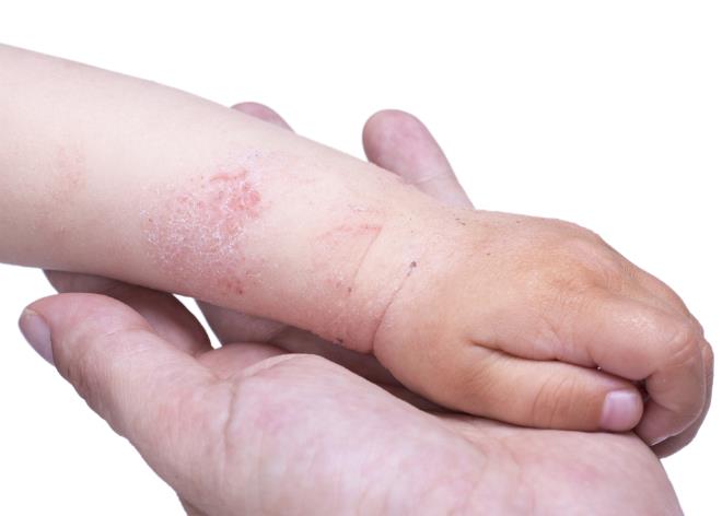 如果你的宝宝有湿疹，应该记住这四个护理措施，以便快速好转