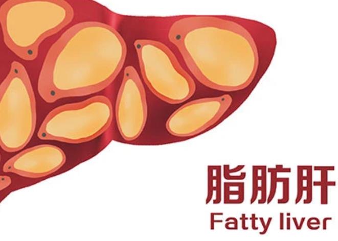 肥胖人群最容易的脂肪肝，5种方法帮你甩掉脂肪肝