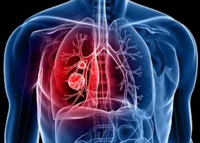 患肺癌的人越来越多，除了吸烟，这三个原因值得深思