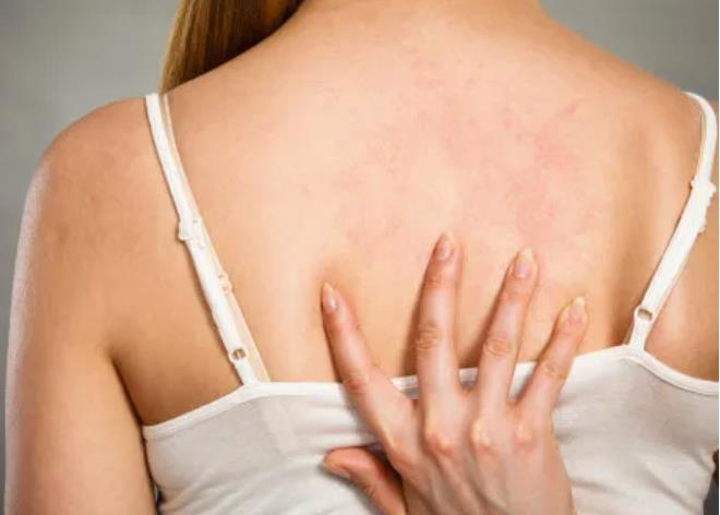 ​湿疹瘙痒不停止，你能感染吗? 预防可以从食物开始